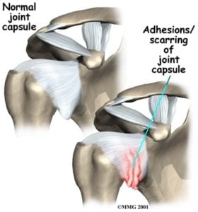 What is a frozen shoulder