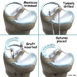 meniscus replacement